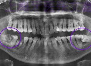 成人磨牙解压方法图片视频,探索成人磨牙的趣味减压图片与视频集锦