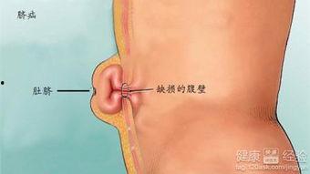 成人脐疝绑带的视频,轻松应对健康困扰