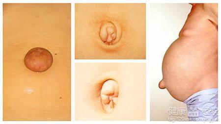 成人脐疝绑带的视频,轻松应对健康困扰