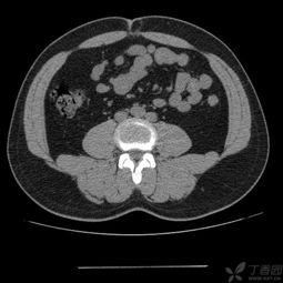 成人脐疝绑带的视频,轻松应对健康困扰