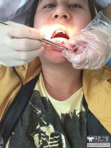 成人自己拔牙齿的视频,牙痛难忍？揭秘成人拔牙全过程
