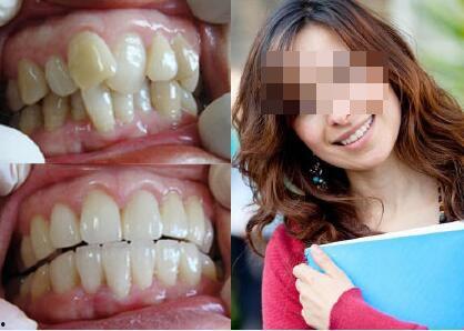 成人自己拔牙齿的视频,牙痛难忍？揭秘成人拔牙全过程  第2张